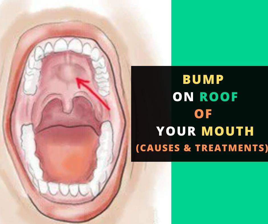 Bump on roof of your mouth
