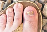 How can old people avoid the risk of toenail fungus
